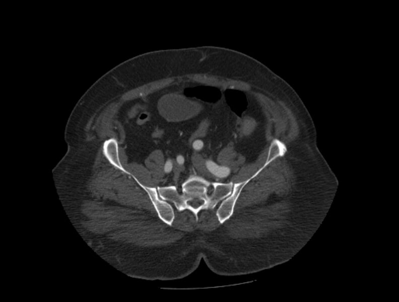 File:Aortic dissection (Radiopaedia 28802-29105 A 85).jpg