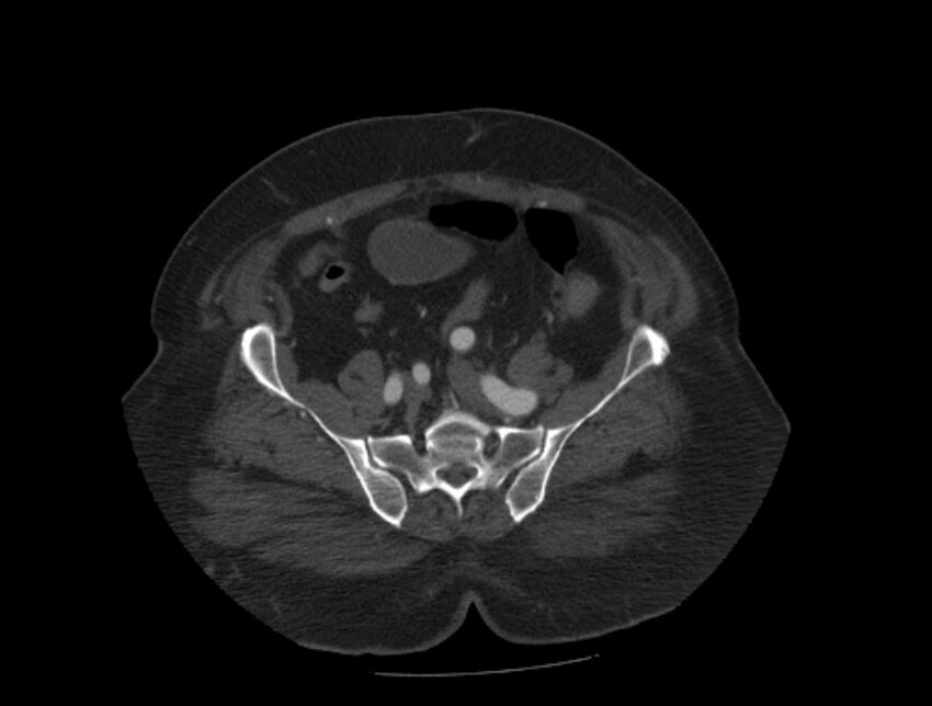 Aortic dissection (Radiopaedia 28802-29105 A 85).jpg