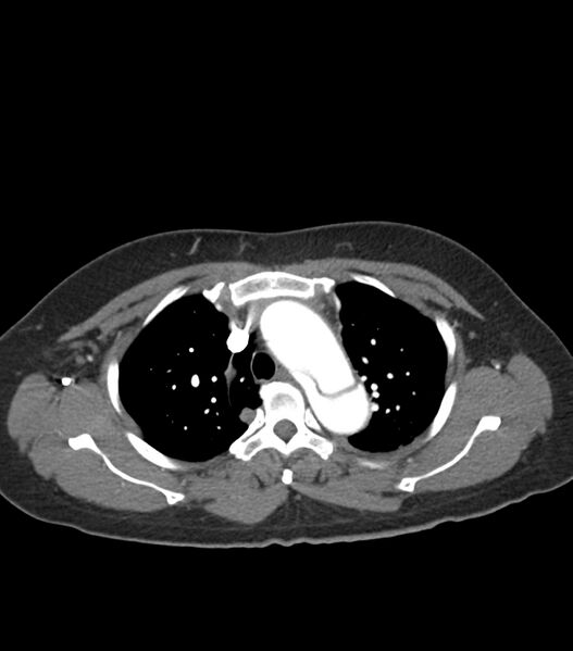File:Aortic dissection with renal ischemia (Radiopaedia 76573-88338 A 14).jpg