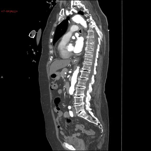 File:Aortic intramural hematoma (Radiopaedia 27746-28001 C 33).jpg