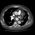 Aorto-coronary bypass graft aneurysms (Radiopaedia 40562-43157 A 59).png