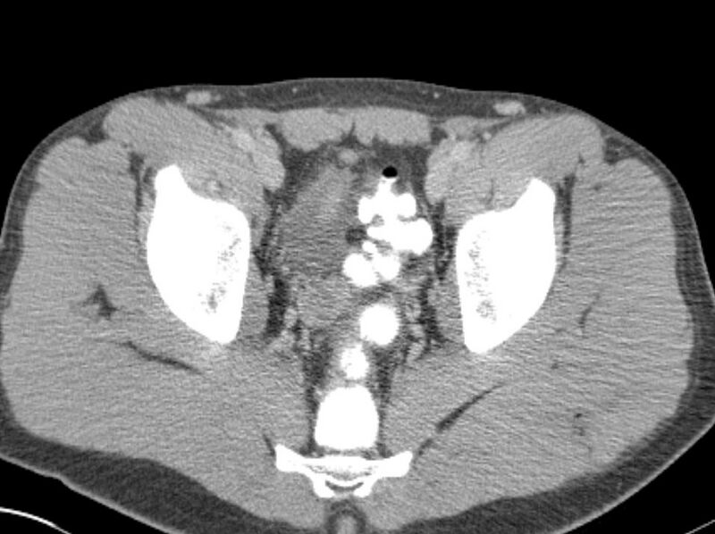 File:Appendicitis and incidental foregut duplication cyst (Radiopaedia 52962-58916 A 92).jpg