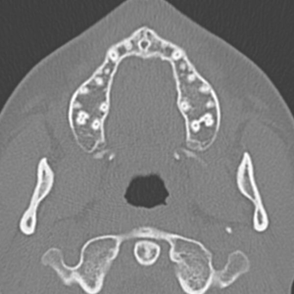 File:Arrested pneumatization of the sphenoid (Radiopaedia 10700-11172 Axial non-contrast 23).jpg