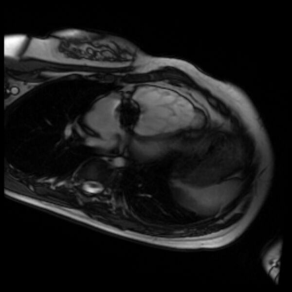 File:Arrhythmogenic right ventricular cardiomyopathy (Radiopaedia 87505-103850 4ch Cine SSFP 97).jpg