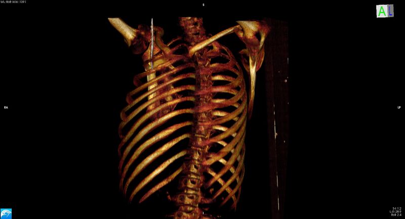 File:Arrow injury to the neck (Radiopaedia 75225-86323 3D bone 5).jpg