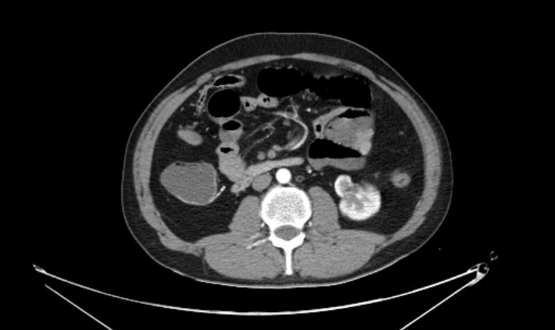 File:Arterial occlusive mesenteric ischemia (Radiopaedia 84641-100060 A 65).jpg