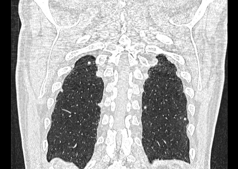 File:Asbestos pleural placques (Radiopaedia 57905-64872 Coronal lung window 255).jpg