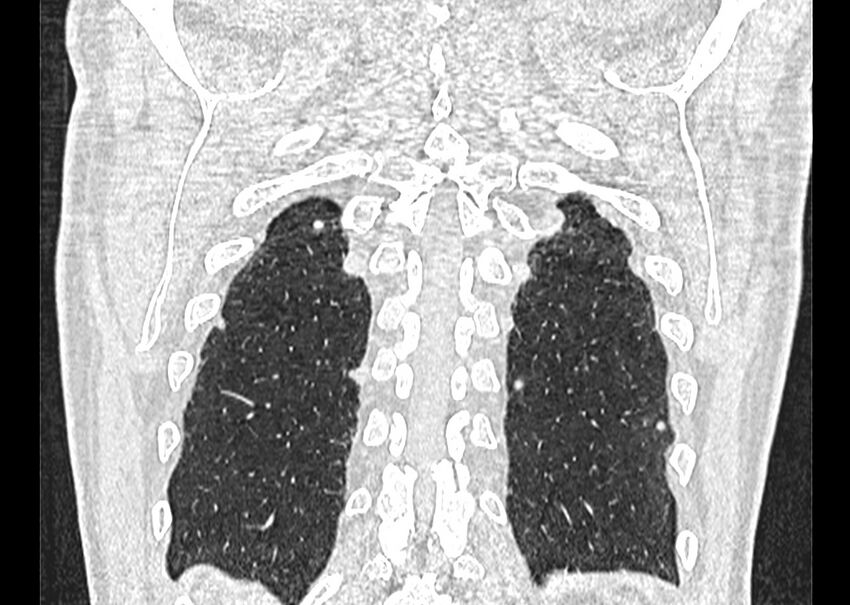 Asbestos pleural placques (Radiopaedia 57905-64872 Coronal lung window 255).jpg