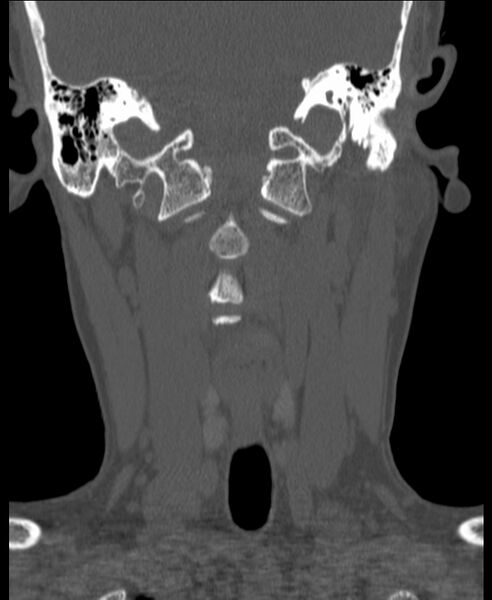 File:Atlanto-occipital assimilation with basilar invagination (Radiopaedia 70122-80188 Coronal bone window 65).jpg