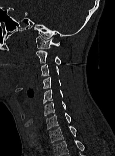 File:Atlantoaxial subluxation (Radiopaedia 44681-48450 Sagittal bone window 105).jpg