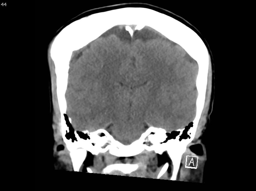 Atypical meningioma - intraosseous (Radiopaedia 64915-73867 B 43).jpg