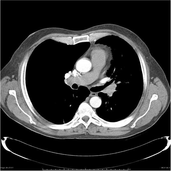 File:Atypical pneumonia - Q fever (Radiopaedia 21993-21989 C+ arterial phase 22).jpg