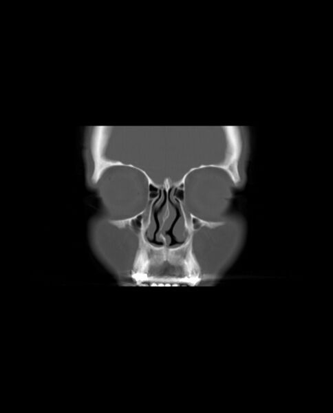 File:Automastoidectomy with labyrinthine fistula (Radiopaedia 84143-99411 Coronal non-contrast 13).jpg