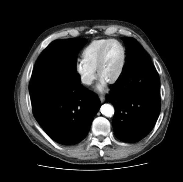 File:Autosomal dominant polycystic kidney disease (Radiopaedia 27851-28094 B 42).jpg
