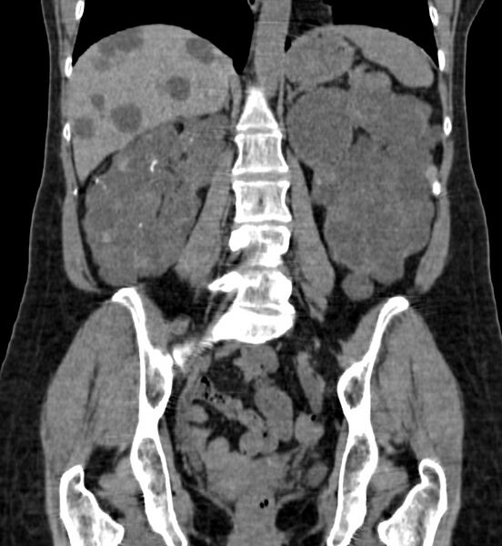 File:Autosomal dominant polycystic kidney disease (Radiopaedia 41918-44922 Coronal non-contrast 30).jpg