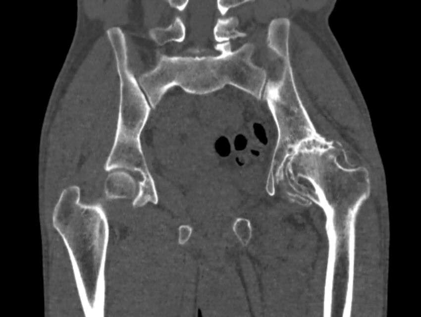 Avascular necrosis of the left hip (Radiopaedia 75068-86125 Coronal bone window 44).jpg