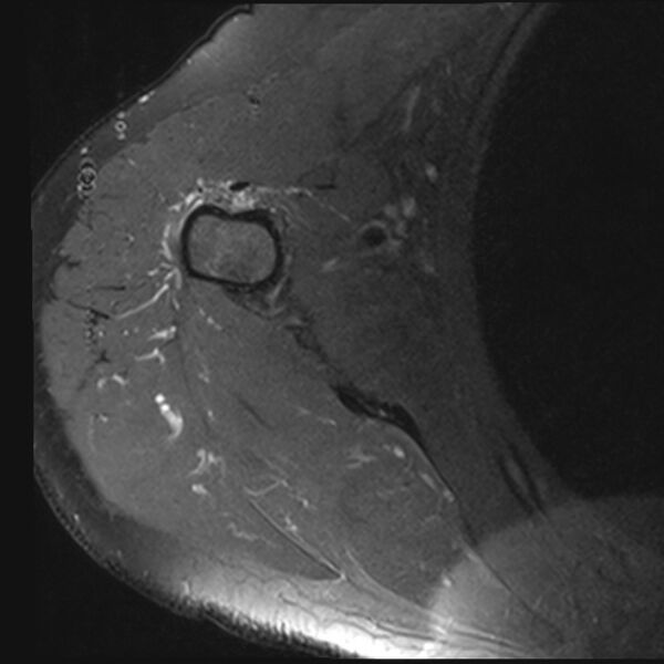 File:Avulsion fracture - greater tuberosity of humerus (Radiopaedia 71216-81515 Axial PD fat sat 2).jpg