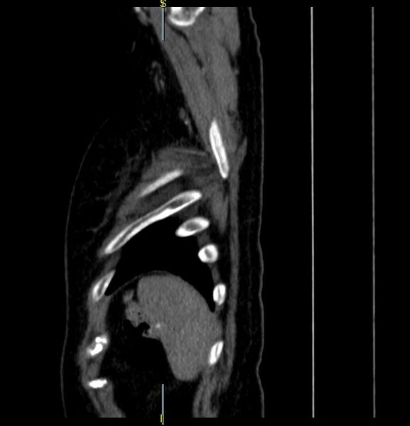 File:Azygos vein aneurysm (Radiopaedia 77824-90130 D 3).JPG