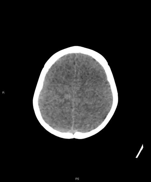 File:Basal ganglia and parenchymal ischemia (Radiopaedia 45818-50083 Axial non-contrast 8).jpg