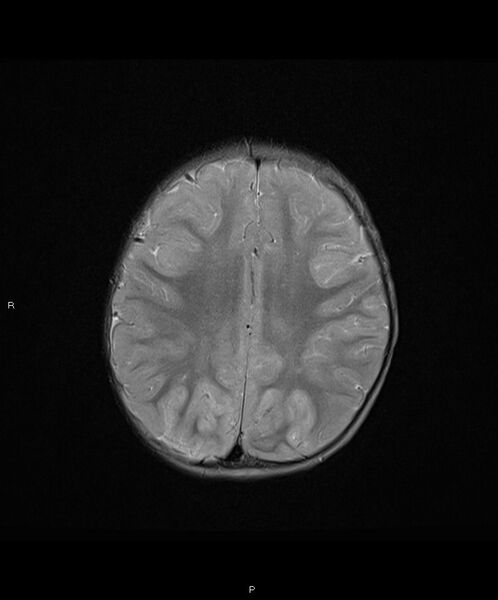 File:Basal ganglia and parenchymal ischemia (Radiopaedia 45818-50084 Axial T2 15).jpg