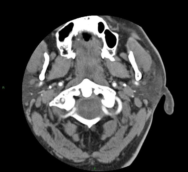 File:Basal ganglia hemorrhage (Radiopaedia 58763-65985 D 3).jpg