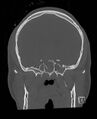 Base of skull fracture with bilateral Le Fort fractures (Radiopaedia 47094-51638 Coronal bone window 59).jpg
