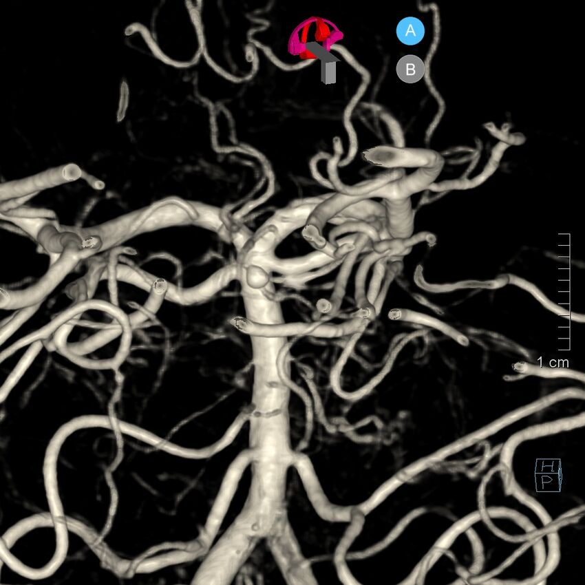Basilar artery perforator aneurysm (Radiopaedia 82455-97734 3D view left VA 157).jpg