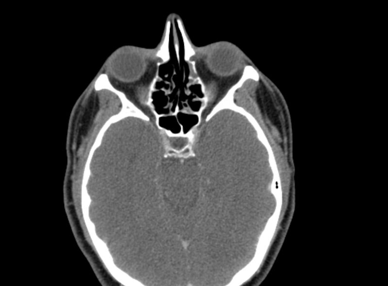 File:Benign mixed salivary tumor of the parotid gland (Radiopaedia 35261-36792 A 3).jpg