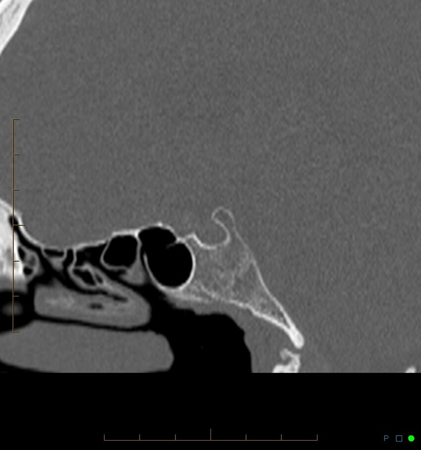 Benign notochordal cell tumor (probable) (Radiopaedia 65475-74546 Sagittal bone window 16).jpg