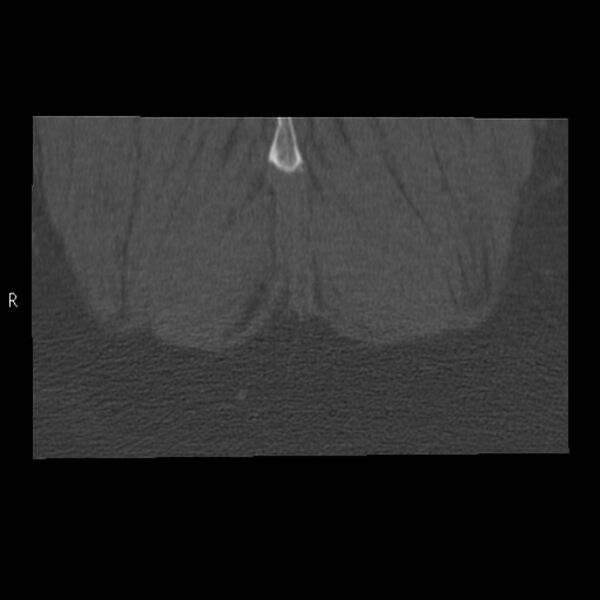 File:Bertolotti syndrome (Radiopaedia 24864-25128 Coronal bone window 57).jpg