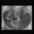 Bicornuate-septate uterus (Radiopaedia 59888-67354 C 1).JPEG