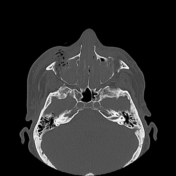 File:Bilateral Le Fort fractures (Radiopaedia 32192-33135 Axial bone window 56).jpg