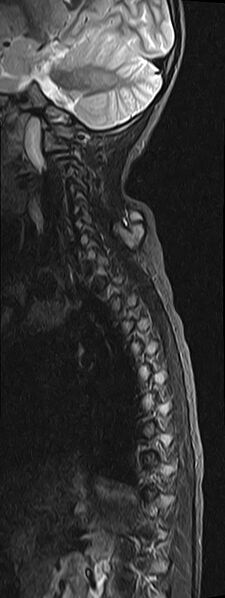 File:Bilateral Sprengel deformity with Klippel-Feil syndrome (Radiopaedia 66395-75650 Sagittal STIR 10).jpg