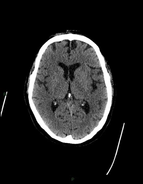 File:Bilateral acute middle cerebral artery territory infarcts (Radiopaedia 77319-89401 Axial non-contrast 44).jpg