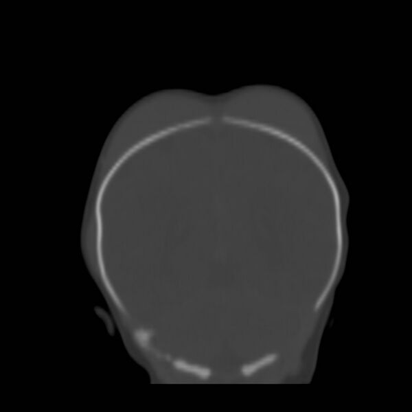 File:Bilateral cephalohematomas and subdural hematomas (Radiopaedia 26778-26929 Coronal bone window 22).jpg