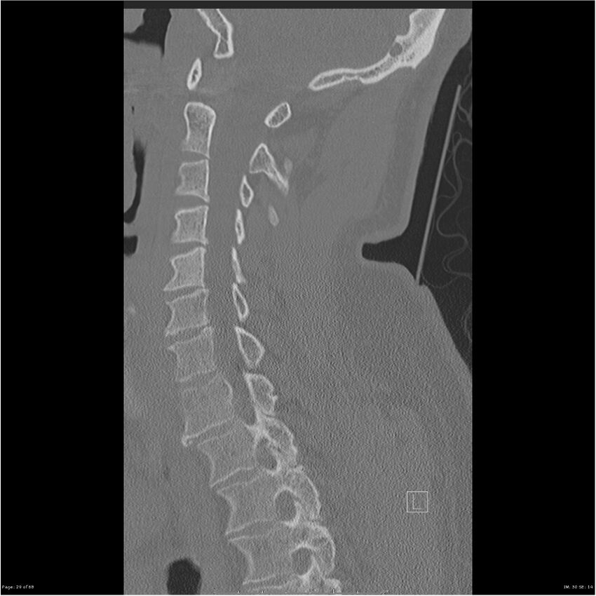 Bilateral cervical ribs (Radiopaedia 25868-26017 Sagittal bone window 29).jpg