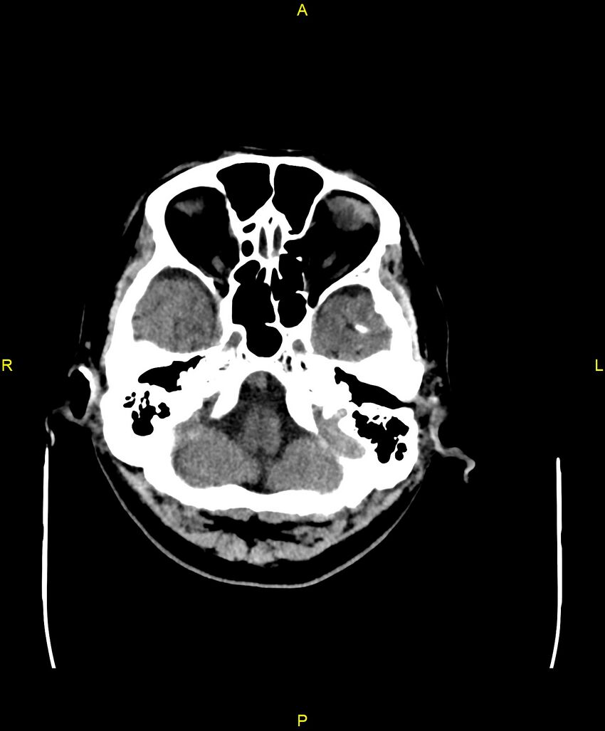 Bilateral isodense subdural hematomas (Radiopaedia 88621-105325 Axial non-contrast 17).jpg