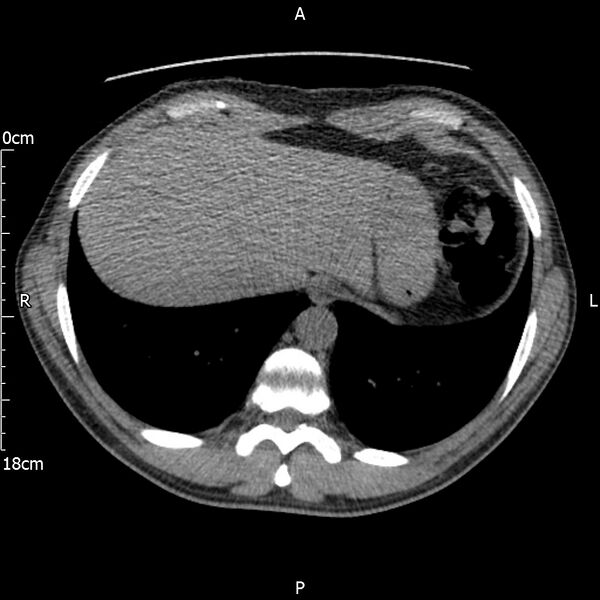File:Bilateral medullary nephrocalcinosis with ureteric calculi (Radiopaedia 71269-81569 Axial non-contrast 4).jpg