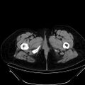 Bilateral ovarian mature cystic teratomas (Radiopaedia 79373-92457 Axial non-contrast 107).jpg