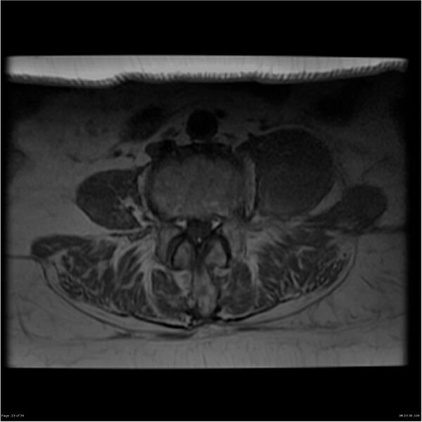 File:Bilateral psoas hematomas (Radiopaedia 24057-24280 T1 23).jpg