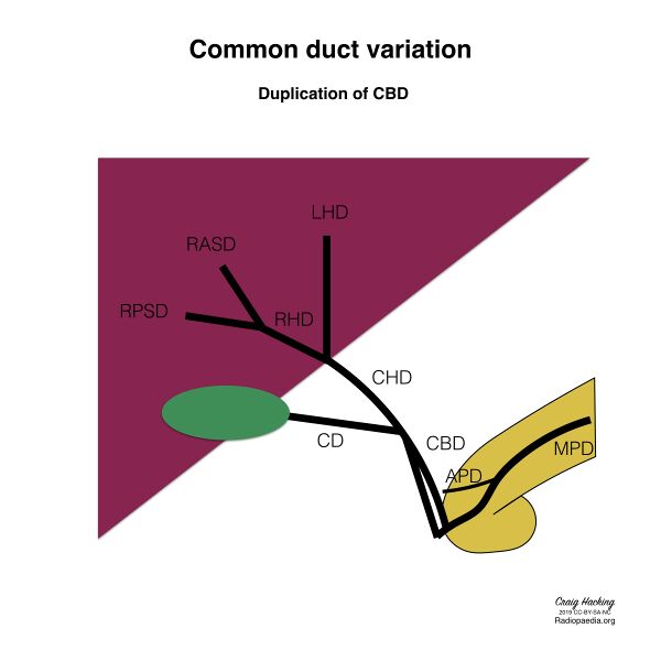 File:Biliary duct anatomic variation (diagram) (Radiopaedia 70380-80479 Common ducts 3).jpeg