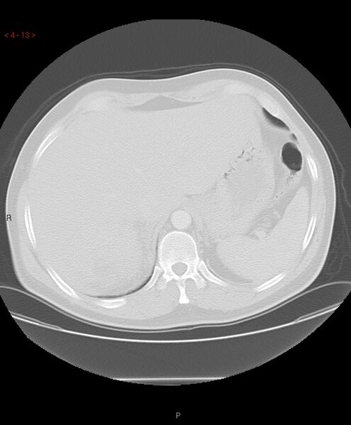 File:Birt-Hogg-Dubé syndrome (Radiopaedia 53814-60013 Axial lung window 13).jpg