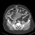 Bladder papillary urothelial carcinoma (Radiopaedia 48119-52951 Axial 41).png