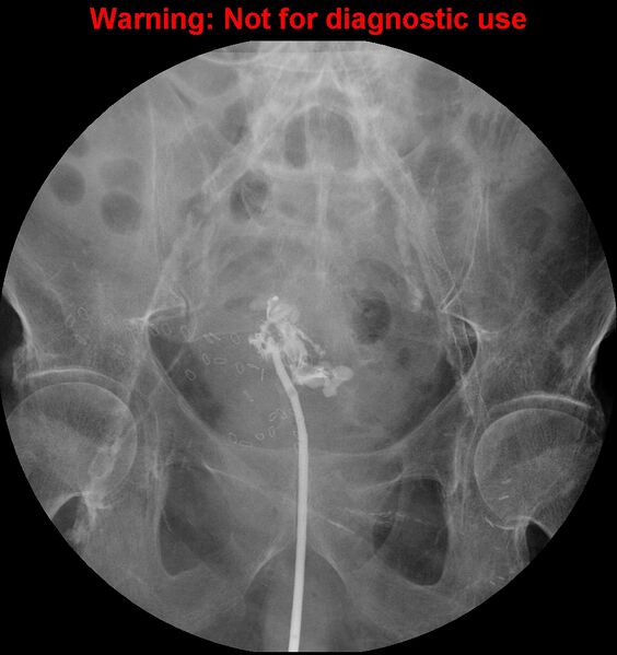 File:Bladder rupture (intraperitoneal) (Radiopaedia 41057-43807 cystogram 1).jpg