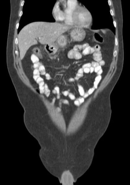 File:Bleeding duodenal ulcer and adenomyomatosis of gallbladder (Radiopaedia 61834-69861 B 64).jpg