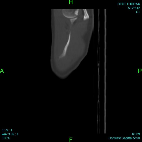 File:Bone metastases from lung carcinoma (Radiopaedia 54703-60937 Sagittal bone window 61).jpg