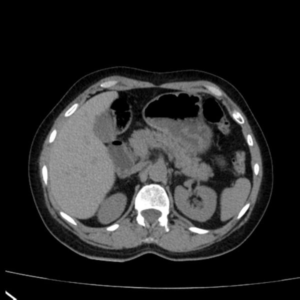 File:Bosniak renal cyst - type I (Radiopaedia 27479-27675 Axial non-contrast 26).jpg