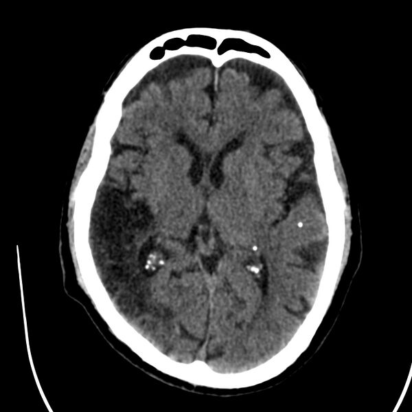 File:Brain Pantopaque remnants (Radiopaedia 78403-91048 Axial non-contrast 51).jpg