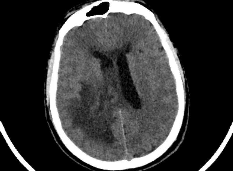 File:Brain abscess complicated by intraventricular rupture and ventriculitis (Radiopaedia 82434-96575 Axial non-contrast 63).jpg