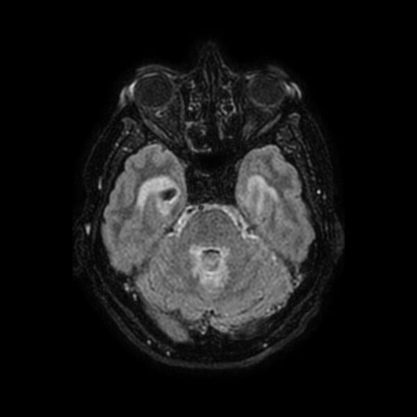File:Brain abscess complicated by intraventricular rupture and ventriculitis (Radiopaedia 82434-96577 Axial FLAIR 17).jpg